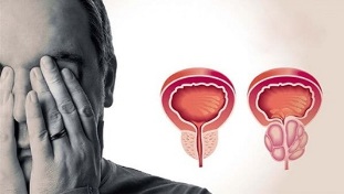 uzroci prostatitisa u muškaraca