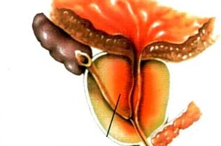 što je prostatitis kod muškaraca