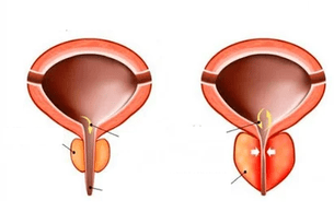 što je akutni prostatitis