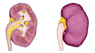 što uzrokuje akutni prostatitis