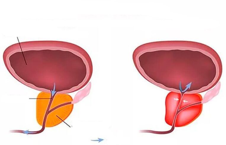 normalna i upaljena prostata