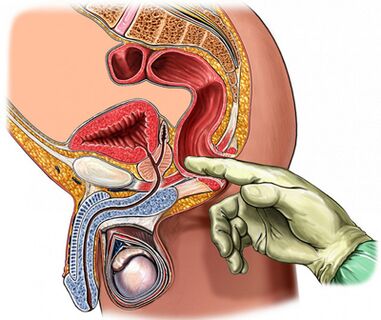 Pregled prostate prstom