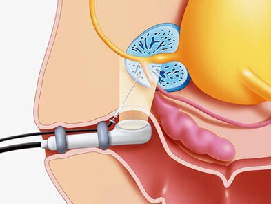 Punkcijska biopsija prostate