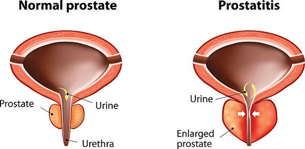 normalna i upaljena prostata