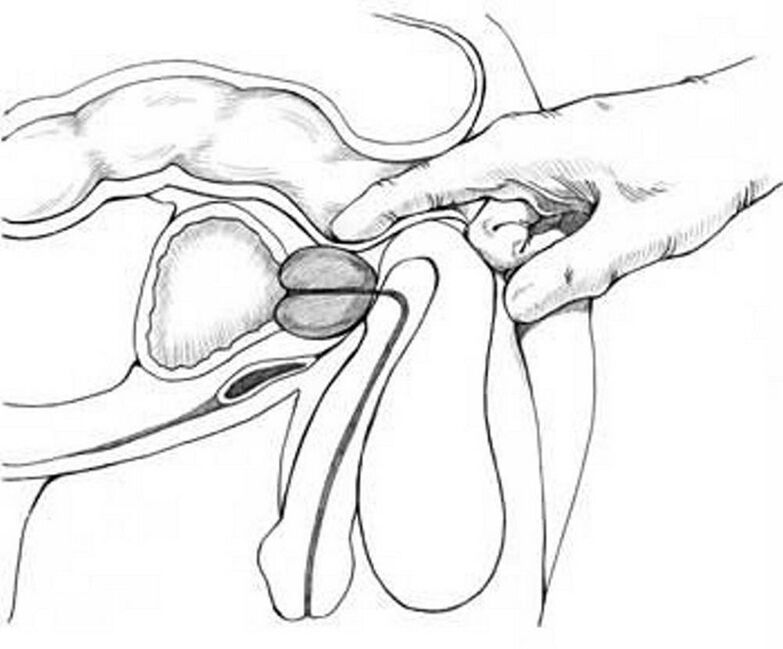 masaža prostate za kronični prostatitis