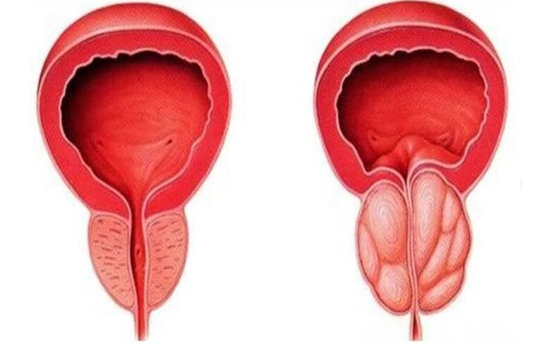 zdrava i upaljena prostata s prostatitisom